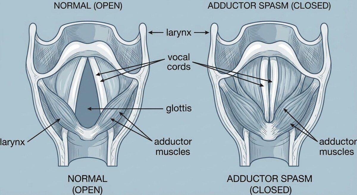 Anatomical diagram of the human larynx and vocal cords showing where involuntary muscle spasms occur in spasmodic dysphonia