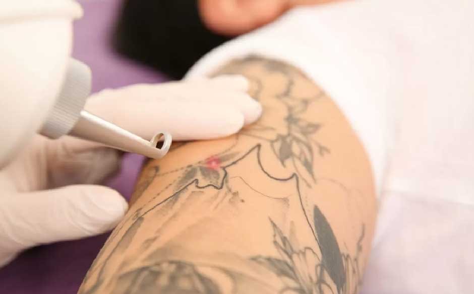 Beginner’s Guide to Choosing a Tattoo Removal Clinic